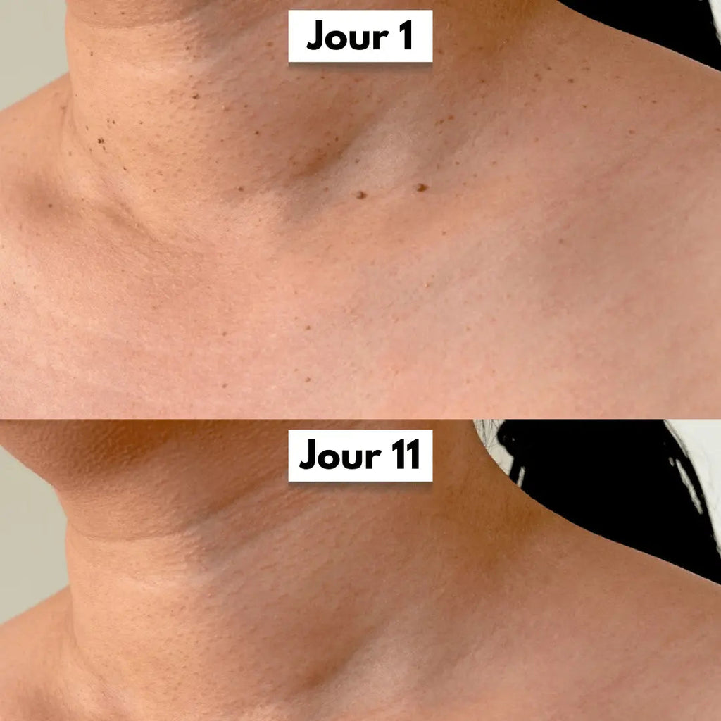 Avant apres cou