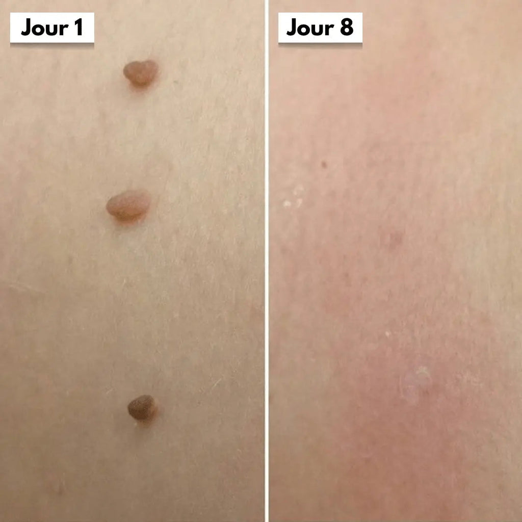 Avant apres bras