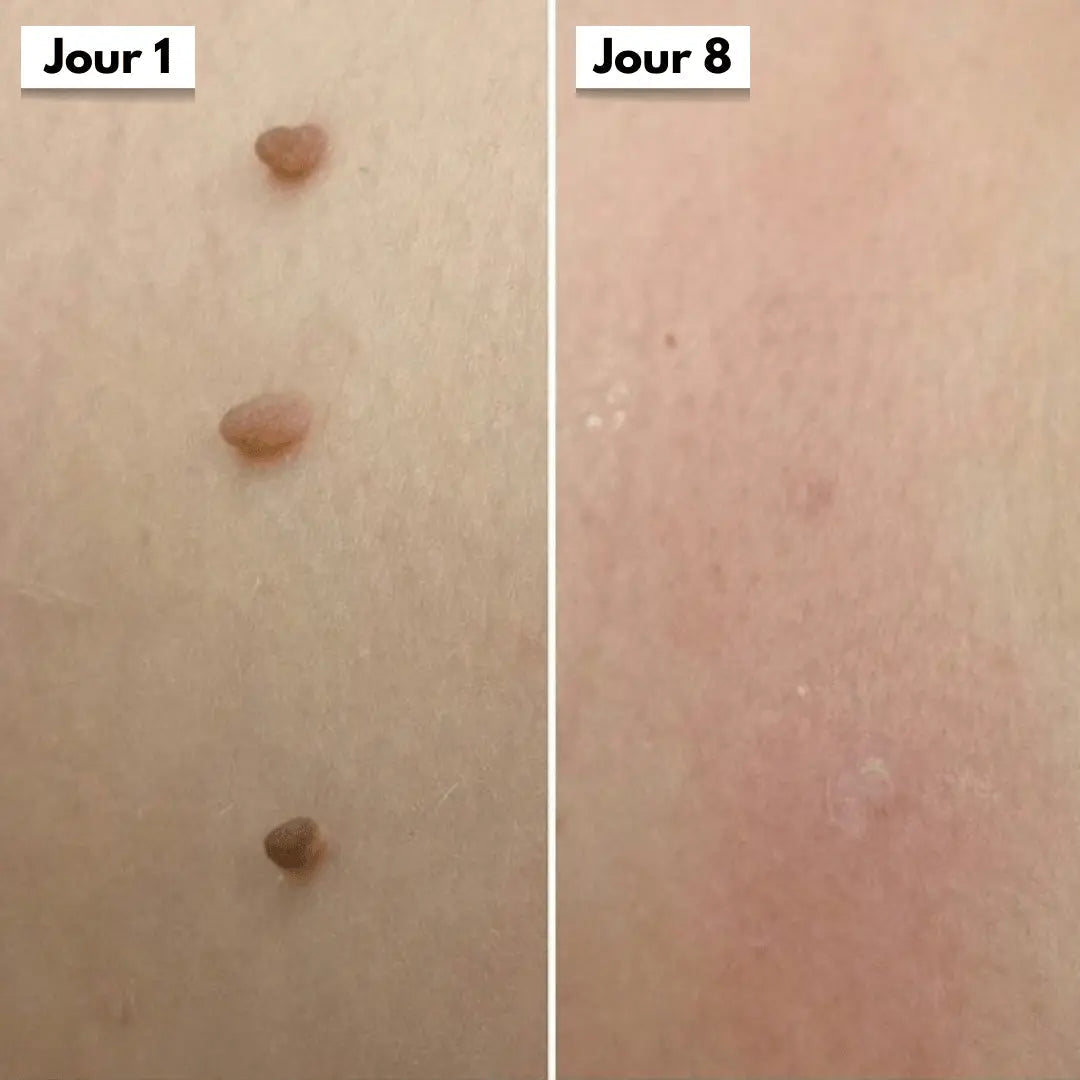Avant apres bras