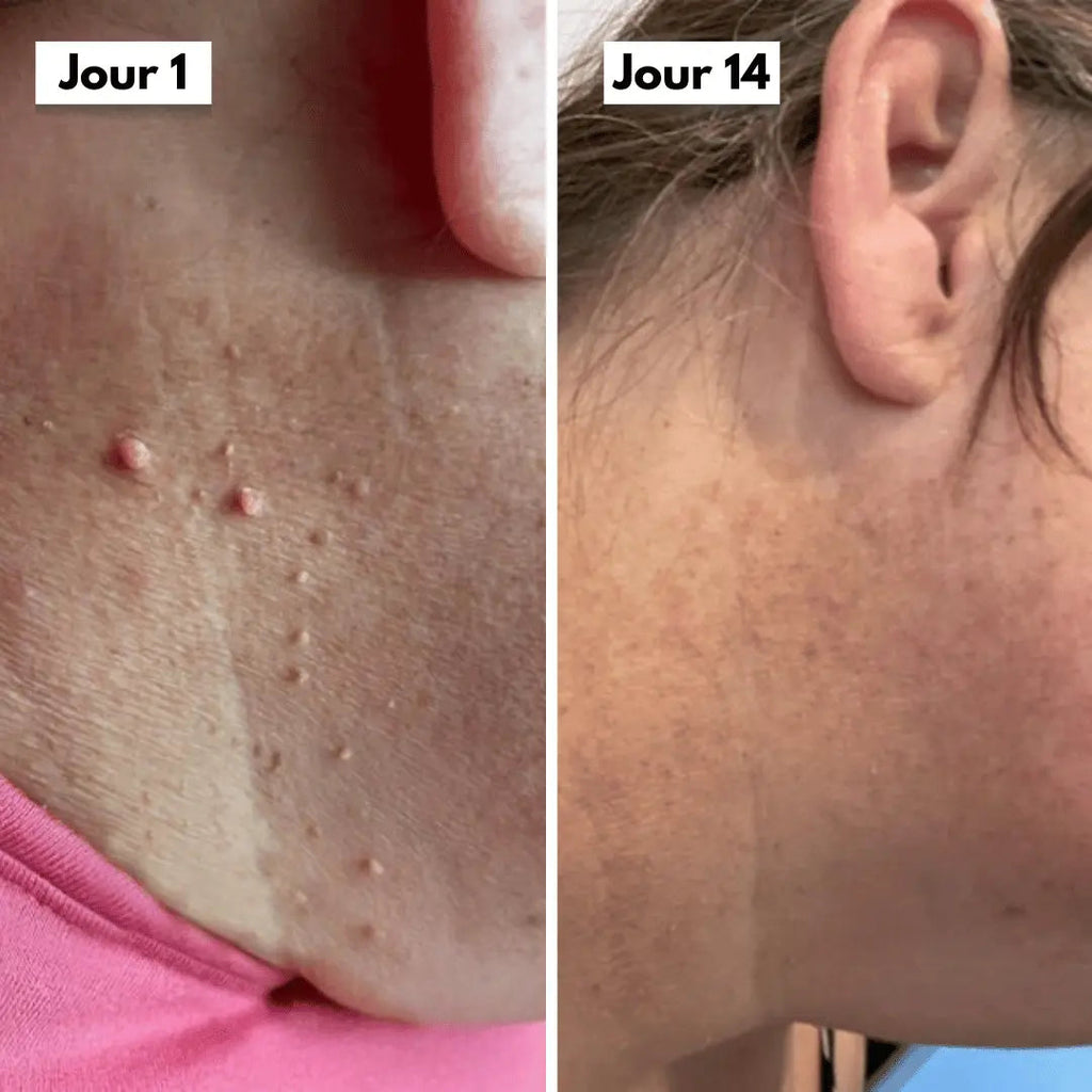 Avant apres cou 14 jours