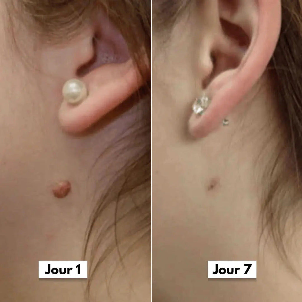 Avant apres oreille