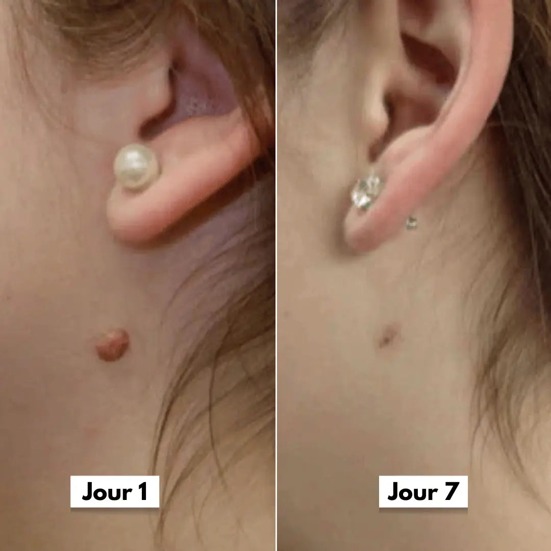 Avant apres oreille
