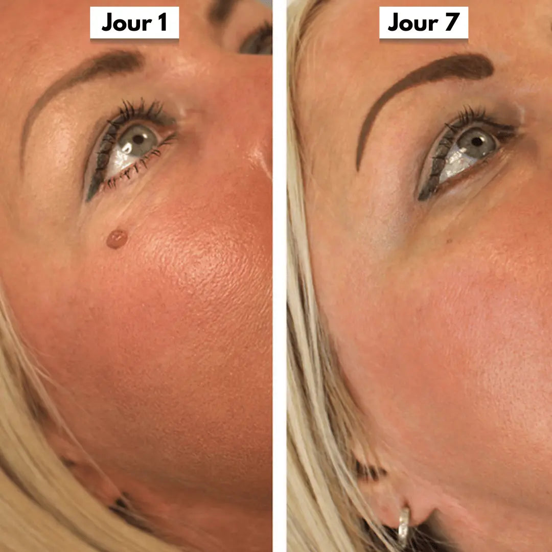 Avant apres oeil