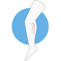 Varices