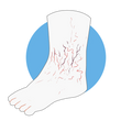 Neuropathie diabétique